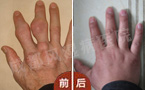 成都风湿医院痛风患者治疗前后手指症状对比4.jpg